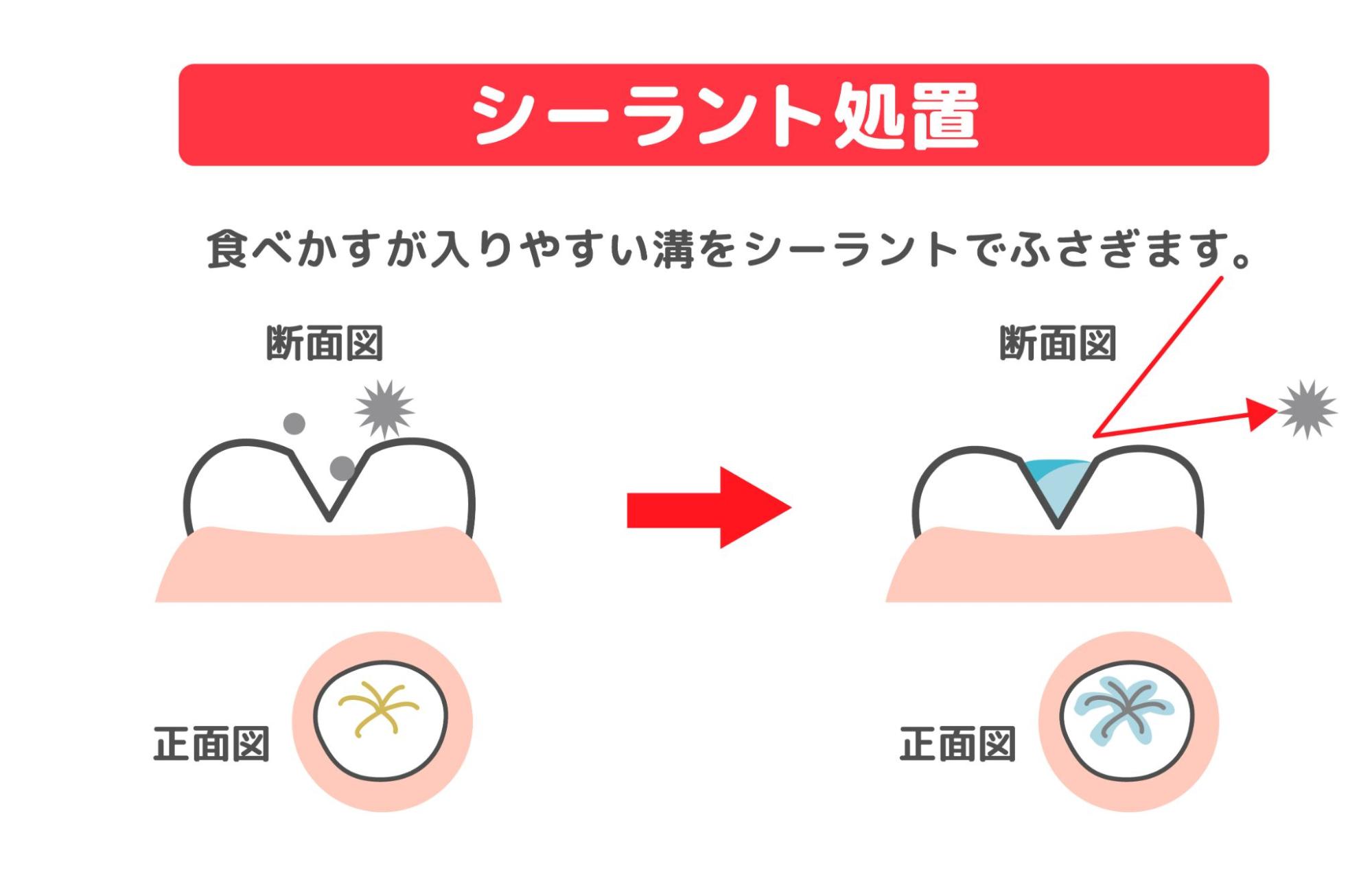 歯科医院での乳歯の虫歯予防