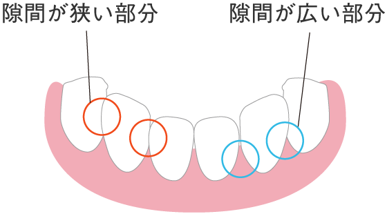隙間が狭い部分と広い部分の歯のイラスト