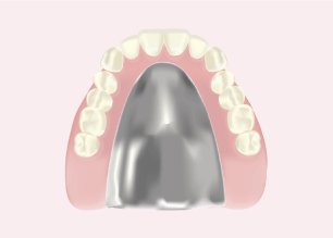 チタンの入れ歯のイラスト