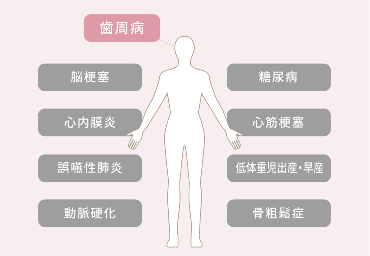 歯周病と全身疾患（脳梗塞、糖尿病、心内膜炎、心筋梗塞、誤嚥性肺炎、低体重児出産・早産、動脈硬化、骨粗鬆症）の関係性を示す、人間のシルエットと疾患名が並んだインフォグラフィック
