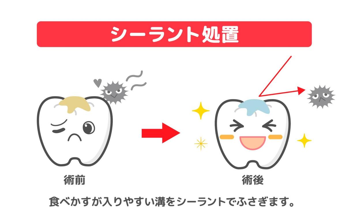 シーラント処置の説明イラスト。術前の食べかすが溜まる溝と、術後にシーラントで溝が塞がれて笑顔になる歯の比較
