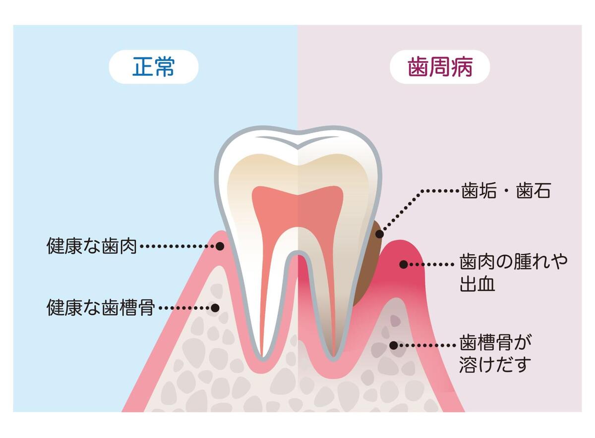 健康な歯肉と歯槽骨を持つ「正常」な状態（左）と、歯垢・歯石が溜まり歯肉の腫れや出血、歯槽骨の減少が見られる「歯周病」の状態（右）を比較した歯の断面イラスト